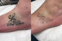 25-34 year old woman treated with Tattoo Removal