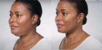 Woman treated with Kybella