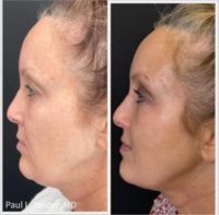45-54 year old woman treated with FaceTite, Morpheus8