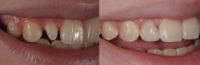17 or under year old woman treated with Dental Bonding