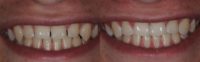Spaces Between Teeth