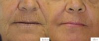Patient treated with Skin Rejuvenation