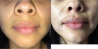 35-year old Latina woman treated with Juvederm