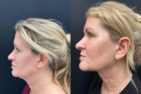 45-54 year old woman treated with FaceTite