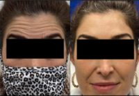 35-44 year old woman treated with Botox on Forehead