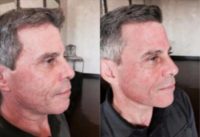 Man treated with Microneedling