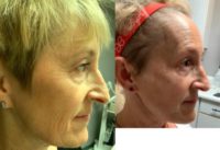 45-54 year old woman treated with Neo Laser, YAG Laser