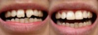 Chipped teeth treated with Dental Bonding