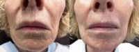Woman treated with Chemical Peel