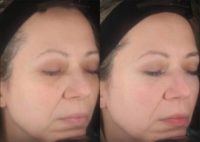 Woman treated with Fractional Laser