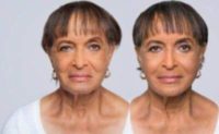 Woman treated with Radiesse and Belotero