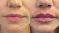 Woman treated with Lip Fillers, Dermal Fillers